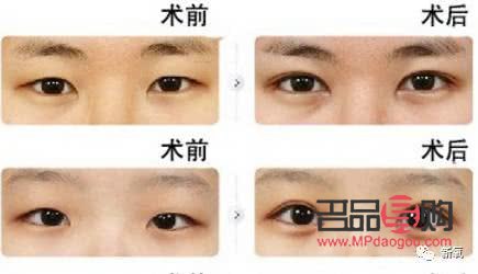 甲亢眼睛突出做手术要多少费用(甲亢眼睛突出做手术要多少费用呢) 甲亢眼睛突出做手术要多少费用(甲亢眼睛突出做手术要多少费用呢)