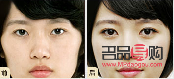 甲亢眼睛突出做手术要多少费用(甲亢眼睛突出做手术要多少费用呢)