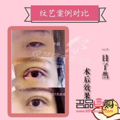 全切双眼皮几天恢复(全切双眼皮几天恢复正常) 全切双眼皮几天恢复(全切双眼皮几天恢复正常)