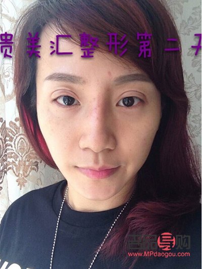 双眼皮定位解析：了解双眼皮美容手术的关键一步