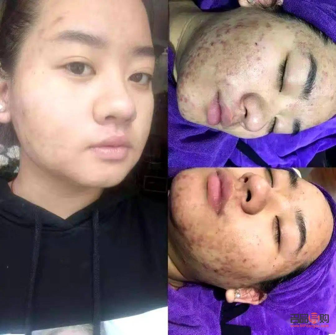 哪家美容院祛痘好(哪家美容院祛痘好)