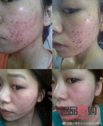 哪家美容院祛痘好(哪家美容院祛痘好)