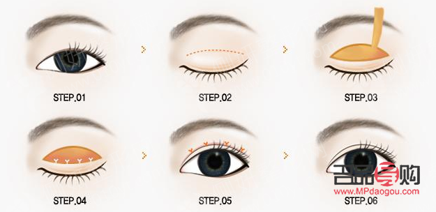 <h3>眼睑重建术：重塑眼部轮廓，重拾自信之美</h3>