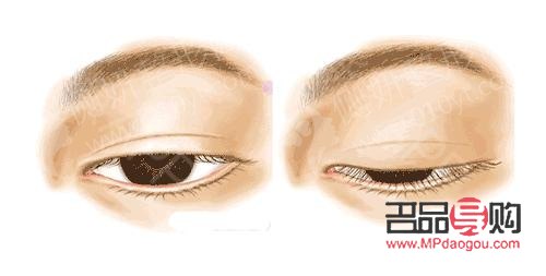 <h3>眼睑重建术：重塑眼部轮廓，重拾自信之美</h3>