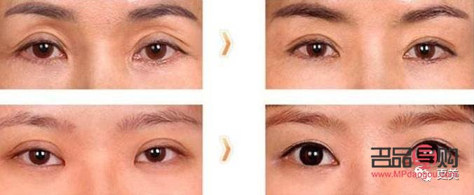 <h3>中国双眼皮修复人：塑造美丽新传奇</h3>
