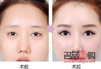 中国双眼皮修复人：塑造美丽新传奇