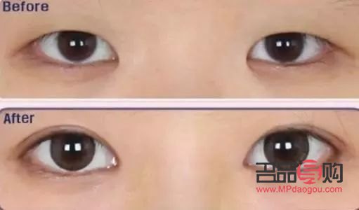 新月型双眼皮：魅力之眼的新选择