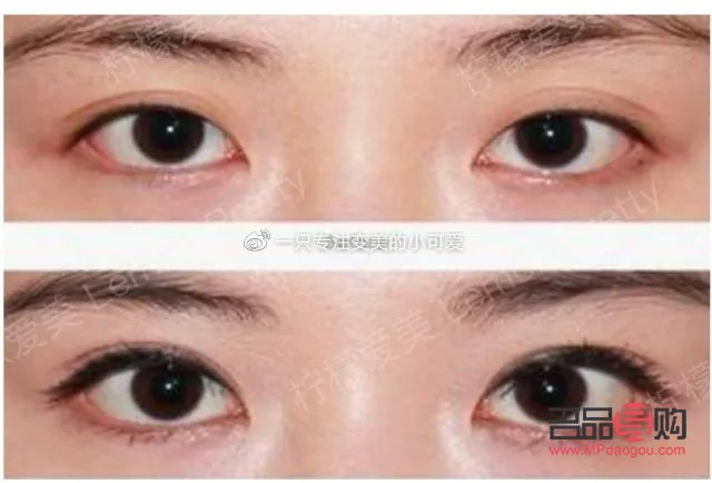 新月型双眼皮：魅力之眼的新选择