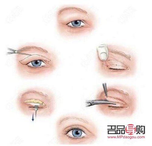<h3>双眼皮手术:现代流行的眼部美容新选择</h3> <h3>双眼皮手术:现代流行的眼部美容新选择</h3>