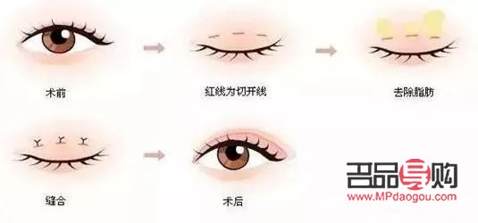 <h3>双眼皮手术:现代流行的眼部美容新选择</h3> <h3>双眼皮手术:现代流行的眼部美容新选择</h3>