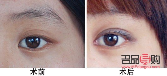 开眼角手术费多少(开眼角手术费多少钱一次)