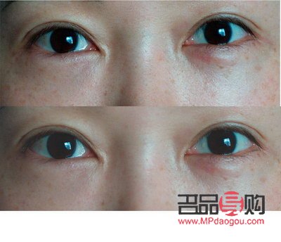 <h3>眼睛手术恢复正常的时长探究</h3> <h3>眼睛手术恢复正常的时长探究</h3>