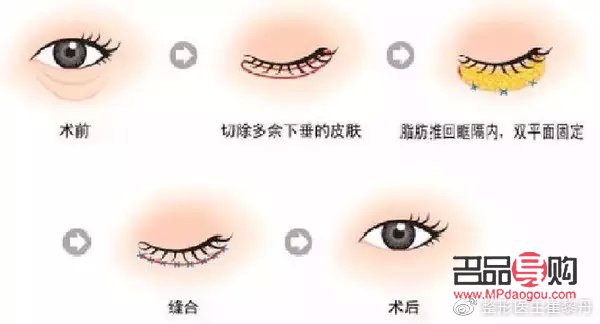 <h3>眼睛手术恢复正常的时长探究</h3> <h3>眼睛手术恢复正常的时长探究</h3>