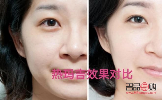 美容缝线多少钱(美容缝线多少钱一针)