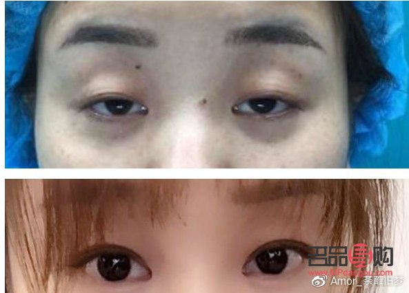 割双眼皮提肌与不提肌的区别(眼睛提肌有必要做吗)