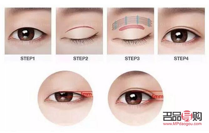 <h3>已有双眼皮是否还能进行埋线手术?</h3> <h3>已有双眼皮是否还能进行埋线手术?</h3>