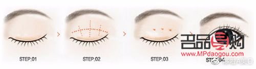 已有双眼皮是否还能进行埋线手术？