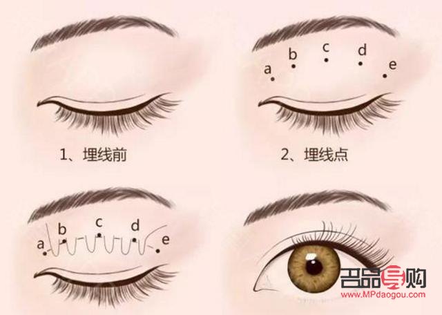 扇形双眼皮显老吗(扇形双眼皮显老吗图片)