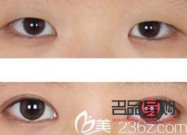 扇形双眼皮显老吗(扇形双眼皮显老吗图片)