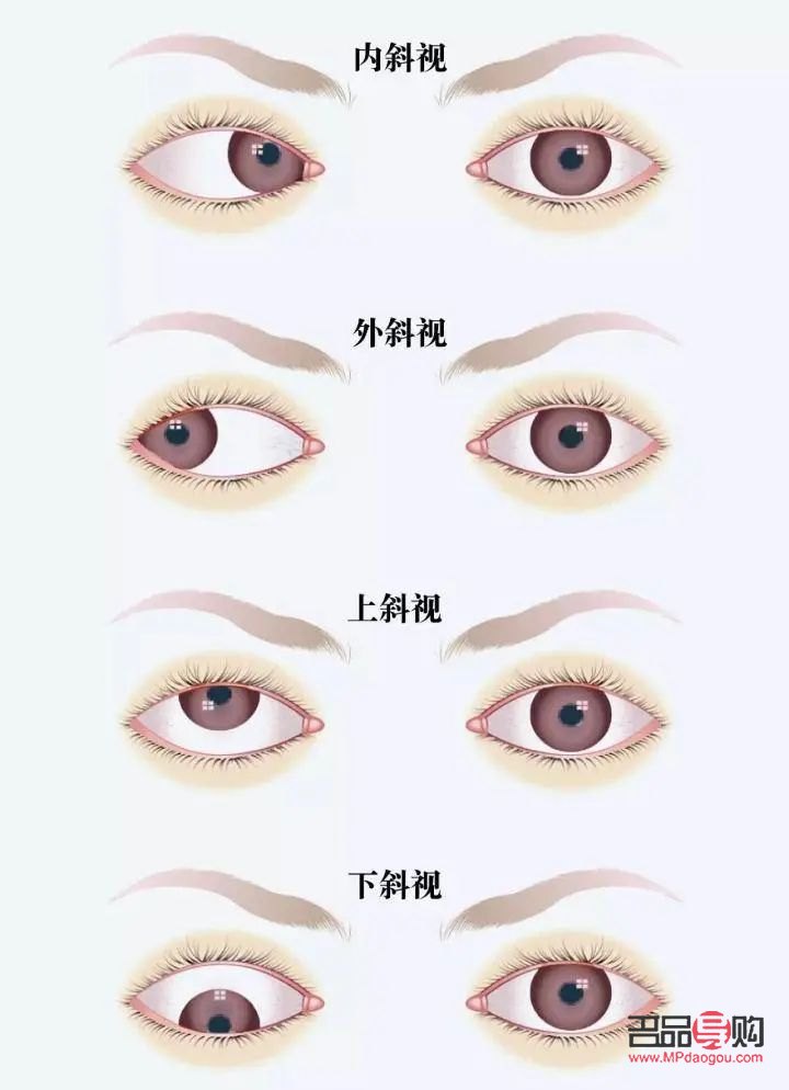 <h3>天生大小眼问题解析：女生是否能进行矫正？</h3>