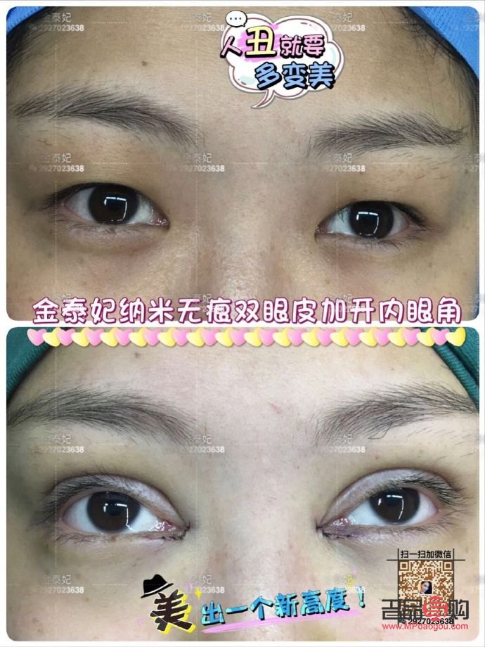 翘睫双眼皮恢复全记录：真实经历与心路历程