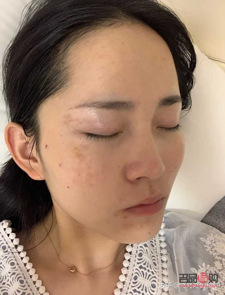 <h3>美容院祛雀斑效果好吗？专业分析与建议</h3>