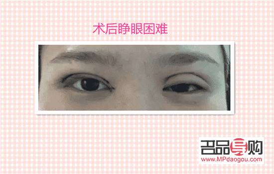 双眼皮手术会有后遗症吗(双眼皮手术会有后遗症吗?)