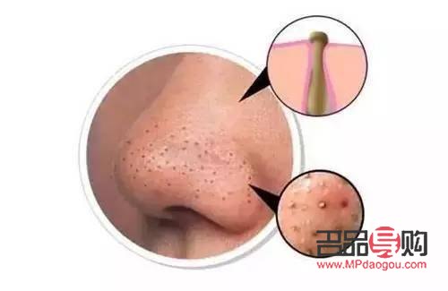 <h1>美容秘诀：如何高效去除黑头</h1>