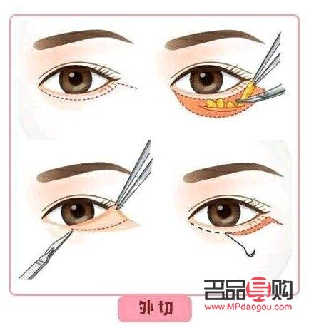 <h3>眼袋手术内切与外切：选择哪个更合适？</h3>
