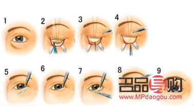 <h3>眼袋手术内切与外切：选择哪个更合适？</h3>