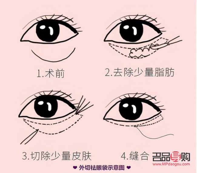 眼袋手术内切与外切：选择哪个更合适？