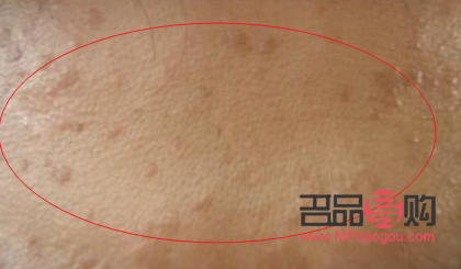 眼周围扁平疣图片(眼周围扁平疣图片大全)