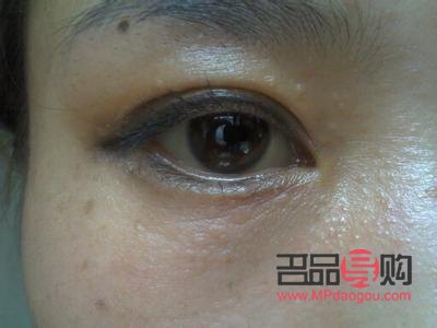 眼周围扁平疣图片(眼周围扁平疣图片大全)