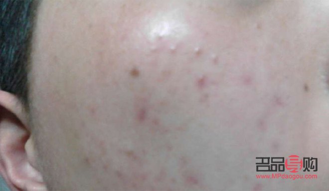 眼周围扁平疣图片(眼周围扁平疣图片大全)