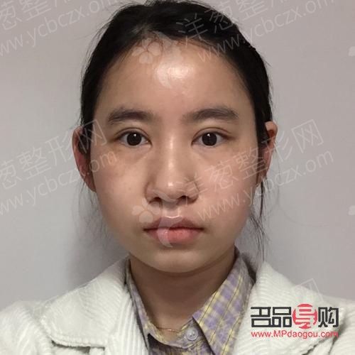 <h3>矫正眼睛一高一低，重塑自信面容</h3>