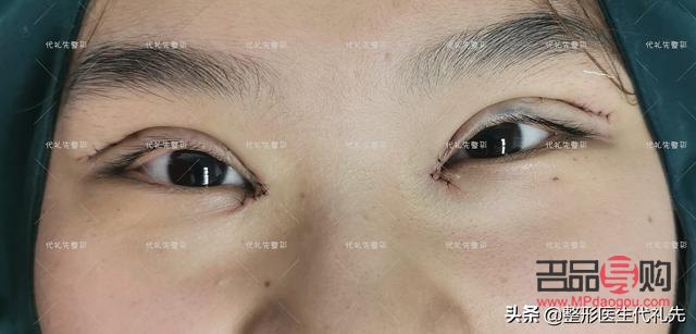 做了大综合双眼皮大概多久恢复好(做大综合双眼皮几天能恢复)