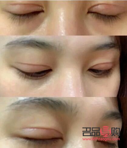 做了大综合双眼皮大概多久恢复好(做大综合双眼皮几天能恢复)