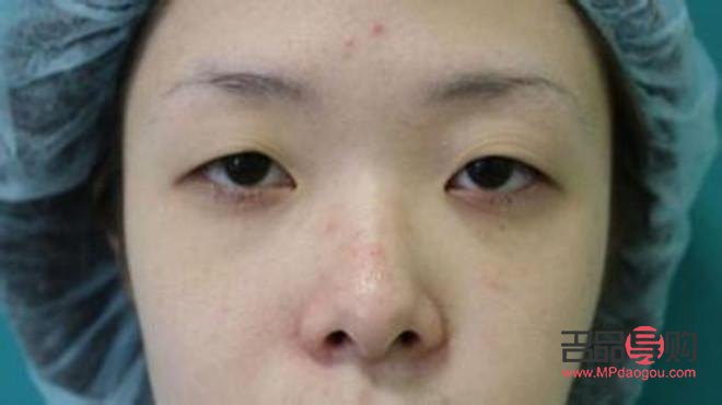 上眼皮松弛下垂做怎么改善(上眼皮松弛下垂做什么最有效) 上眼皮松弛下垂做怎么改善(上眼皮松弛下垂做什么最有效)