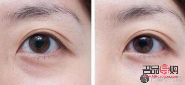 眼眶凹陷怎么恢复饱满 中医治疗(眼眶凹陷怎么恢复饱满 中医治疗方法)