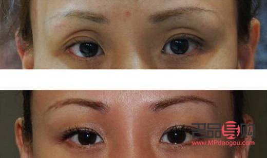 眼眶凹陷怎么恢复饱满 中医治疗(眼眶凹陷怎么恢复饱满 中医治疗方法)