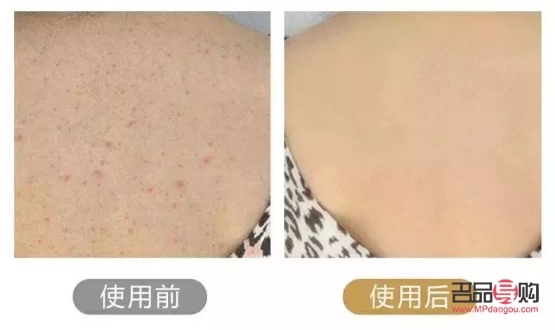 身体毛囊护理怎么做好(身体毛囊护理怎么做好呢)