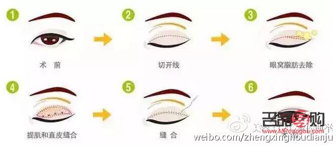 双眼皮之美：探寻最迷人的双眼皮魅力