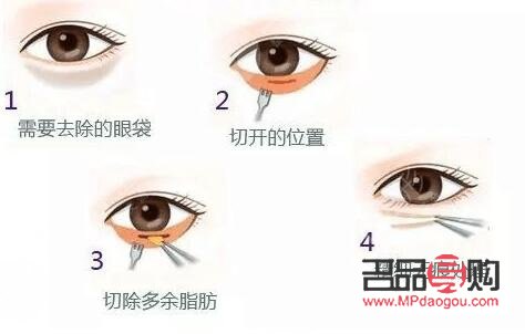 <h3>眼袋切除后是否还会再次生长？</h3>