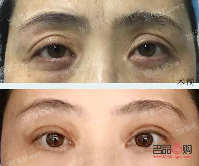 眼睛往里凹陷怎么回事(眼睛往里凹陷怎么回事 吃肉就好了)