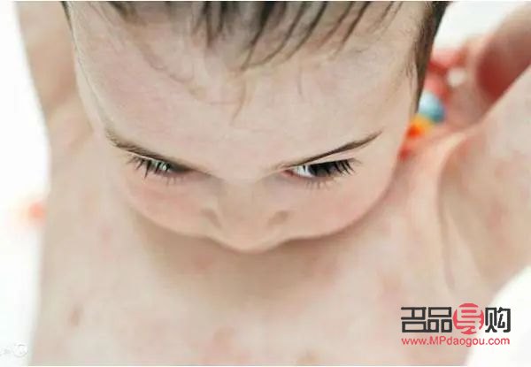 <h3>宝宝身体过敏，如何正确护理？</h3>