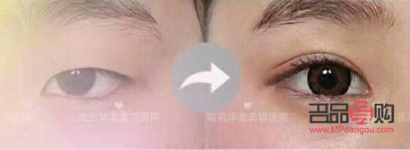 <h3>双眼皮埋线手术效果能持续多久？</h3>