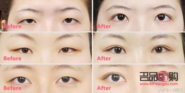 <h3>肿眼泡适合做什么样的双眼皮手术？</h3>