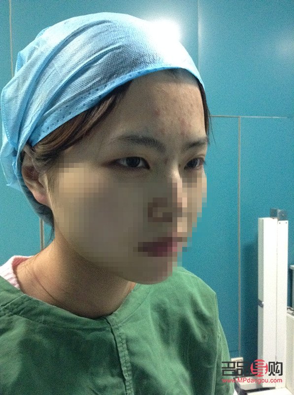 肿眼泡割双眼皮案例(什么年龄割双眼皮最好)