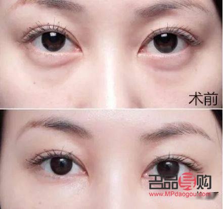 去眼袋术前术后对比照片(去眼袋手术前后图片区别)