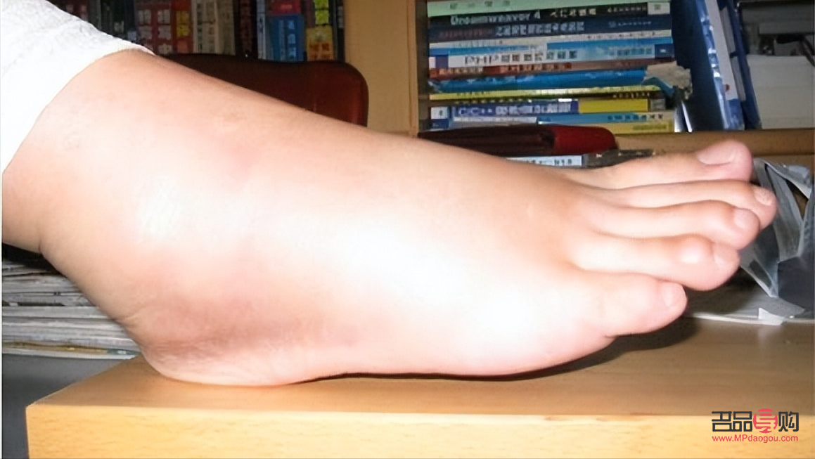 肾病早期眼睛浮肿：不容忽视的警示信号